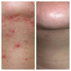 Dermapen and endymed acne and scarring Banbury, Dermapen and endymed acne and scarring Buckinghamshire, Dermapen and endymed acne and scarring Daventry, Dermapen and endymed acne and scarring Leamington Spa, Dermapen and endymed acne and scarring Leicestershire, Dermapen and endymed acne and scarring Milton Keynes, Dermapen and endymed acne and scarring Northampton, Dermapen and endymed acne and scarring Northamptonshire, Dermapen and endymed acne and scarring Rugby, Dermapen and endymed acne and scarring Towcester, Dermapen and endymed acne and scarring Warwickshire