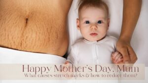 Happy Mother's Day 19 March 2023 - What causes stretch marks and how can you reduce them?
